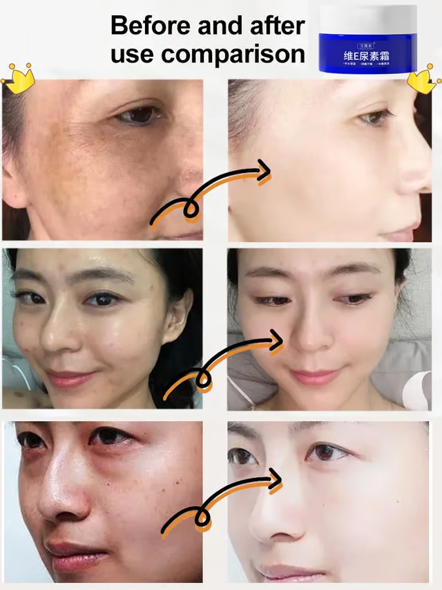 🔥Buy 1 Get 1 Free🔥 Spot Fading Urea Cream